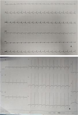 Clinical Characteristics of Congenital Atresia of the Left Main Coronary Artery in 12 Children